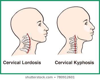 normal-vs-reversal-cervical-lordosis-260nw-780912601.jpg